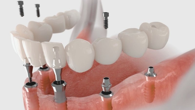 implant-uygulamasi https://www.okyanusdent.com/wp-content/uploads/2023/08/implant-uygulamasi.jpg