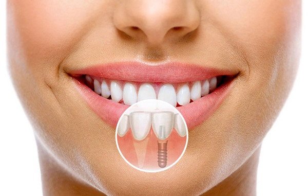 https://www.okyanusdent.com/wp-content/uploads/2024/04/implant.jpg